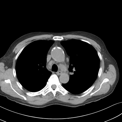 File:Apical pulmonary metastasis (Radiopaedia 46338-50754 B 24).png