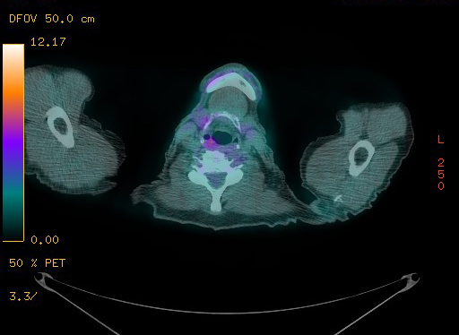 Appendiceal adenocarcinoma complicated by retroperitoneal abscess (Radiopaedia 58007-65041 Axial PET-CT 18).jpg