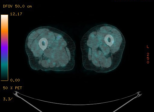 File:Appendiceal adenocarcinoma complicated by retroperitoneal abscess (Radiopaedia 58007-65041 Axial PET-CT 225).jpg