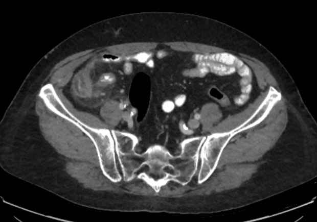 Appendicitis due to chicken fibula (Radiopaedia 74314-85198 A 25).jpg