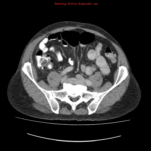File:Appendicitis mass in inguinal hernia (Radiopaedia 26858-27029 A 6).jpg