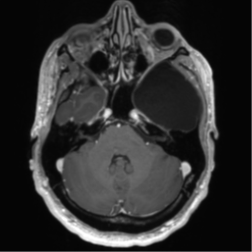 Arachnoid cyst with subdural hematoma (Radiopaedia 85892-101743 Axial T1 C+ 25).png