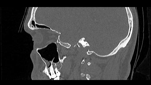 Arcuate foramen (Radiopaedia 89833-106944 Sagittal bone window 11).jpg