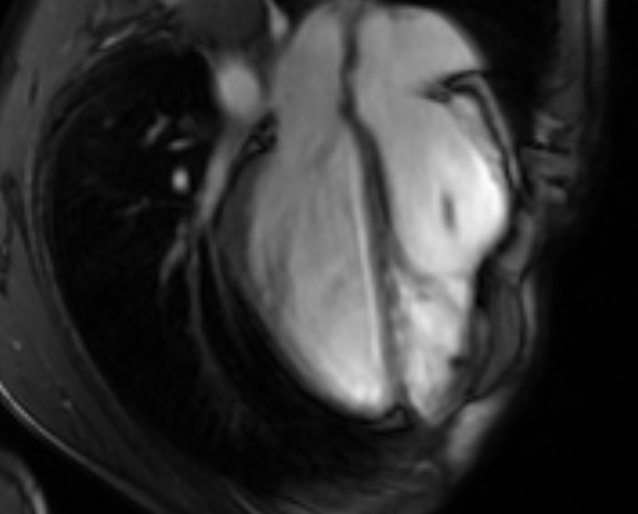 Arrhythmogenic right ventricular cardiomyopathy (Radiopaedia 69564-79464 4ch cine 75).jpg