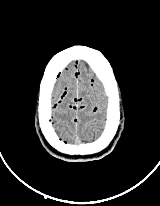 Arrow injury to the brain (Radiopaedia 72101-82607 Axial non-contrast 88).jpg