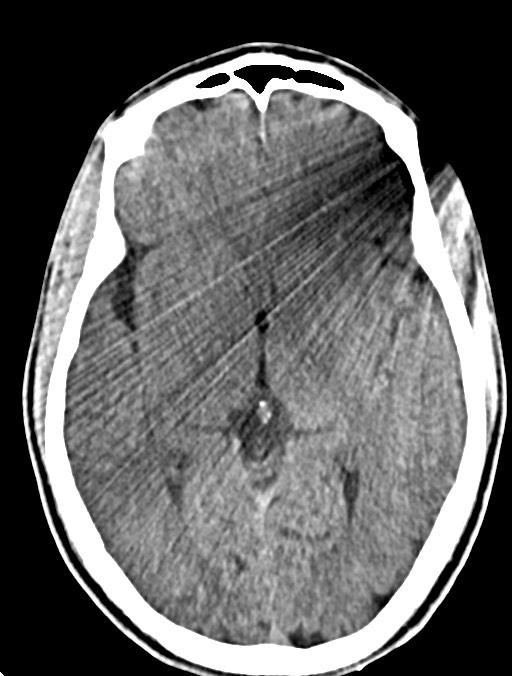 Arrow injury to the head (Radiopaedia 75266-86388 Axial non-contrast 23).jpg