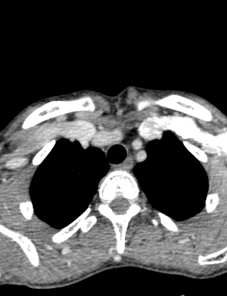 Arteriovenous malformation of the neck (Radiopaedia 53935-60062 B 50).jpg