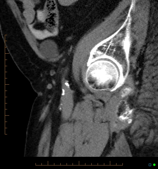 File:Artificial urethral sphincter (Radiopaedia 46937-51464 Sagittal C+ delayed 3).jpg