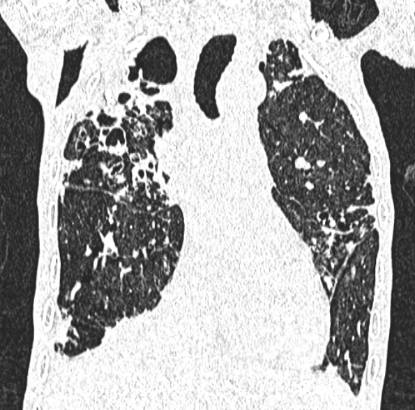 Aspergilloma- with Monod sign (Radiopaedia 44737-48532 Coronal lung window 217).jpg