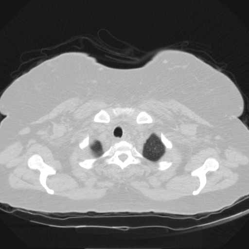Aspergilloma (Radiopaedia 39611-41932 Axial lung window 3).jpg