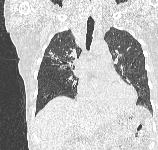 Aspergilloma (Radiopaedia 44592-48327 Coronal lung window 53).jpg