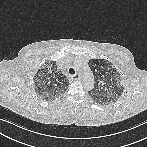 File:Aspergilloma on background pulmonary fibrosis (Radiopaedia 60942-68757 B 16).jpg