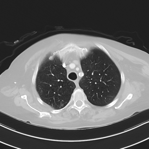 Aspiration bronchiolitis (Radiopaedia 53464-59463 Axial lung window 13).png