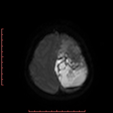 Astroblastoma (Radiopaedia 74287-85162 Axial DWI 91).jpg