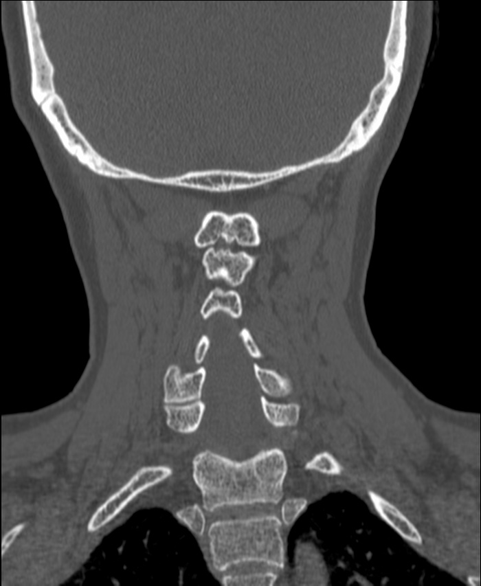Atlanto-occipital assimilation with basilar invagination (Radiopaedia 70122-80188 Coronal bone window 160).jpg