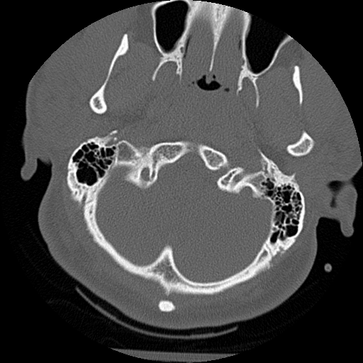 Atlanto-occipital dissociation injury (Radiopaedia 29274-29698 Axial bone window 5).png