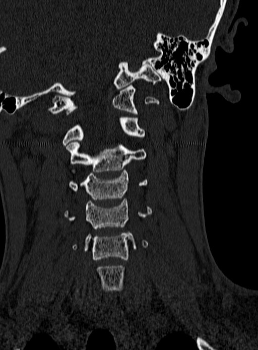 Atlantoaxial subluxation (Radiopaedia 44681-48450 Coronal bone window 54).jpg