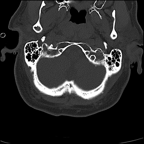 File:Atlas (type 3b subtype 1) and axis (Anderson and D'Alonzo type 3, Roy-Camille type 2) fractures (Radiopaedia 88043-104607 Axial bone window 7).jpg