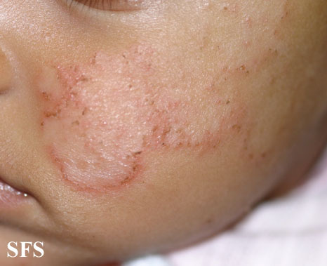 Atopic Dermatitis (Dermatology Atlas 17).jpg