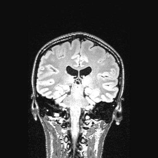 Atretic encephalocoele with inferior vermis hypoplasia (Radiopaedia 30443-31108 Coronal FLAIR 79).jpg
