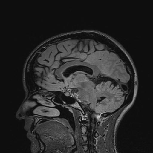 Atretic encephalocoele with inferior vermis hypoplasia (Radiopaedia 30443-31108 Sagittal FLAIR 78).jpg