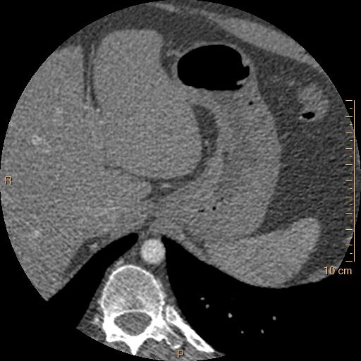 Atrial septal defect (upper sinus venosus type) with partial anomalous pulmonary venous return into superior vena cava (Radiopaedia 73228-83961 A 299).jpg