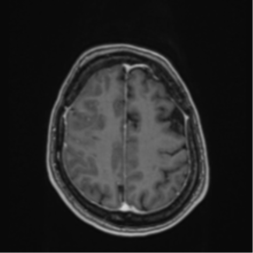 Atypical meningioma (WHO Grade II) (Radiopaedia 54742-60979 Axial T1 C+ 51).png
