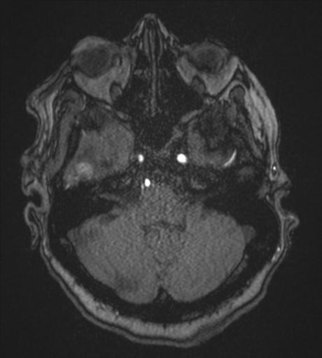 Atypical meningioma (WHO Grade II) (Radiopaedia 54742-60981 Axial MRA 23).png