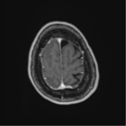 Atypical meningioma (WHO Grade II) (Radiopaedia 54742-60981 Axial T1 C+ 62).png