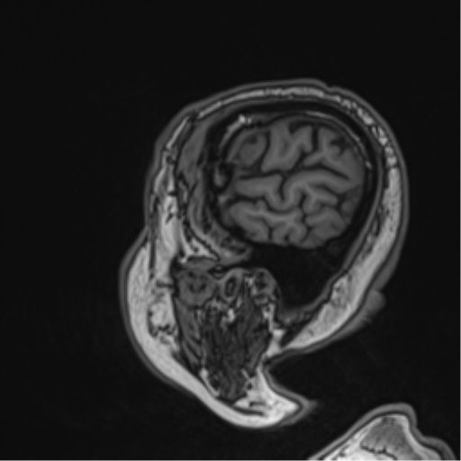 Atypical meningioma (WHO grade II) with brain invasion (Radiopaedia 57767-64729 Sagittal T1 15).png