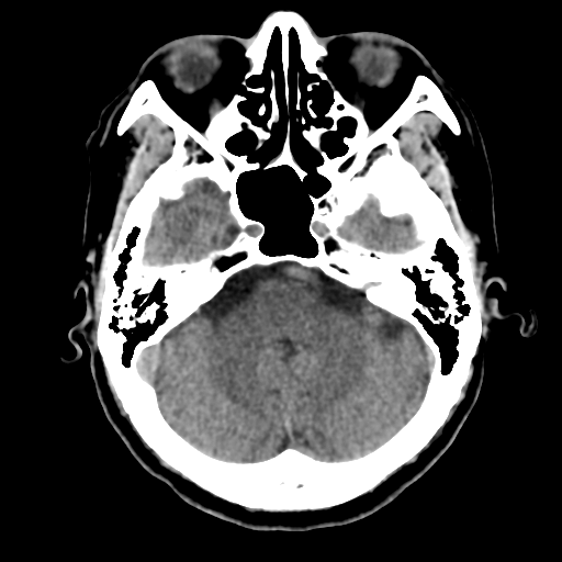 Atypical meningioma (WHO grade II) with osseous invasion (Radiopaedia 53654-59715 Axial non-contrast 15).png