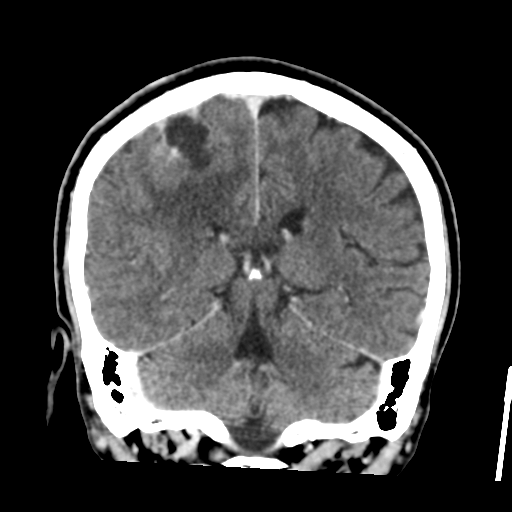 Atypical meningioma with skull invasion (Radiopaedia 34357-35649 Coronal C+ delayed 39).png