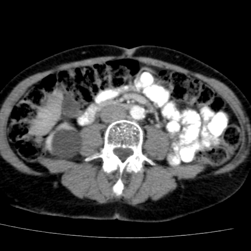 File:Atypical renal cyst (Radiopaedia 17536-17251 renal cortical phase 27).jpg