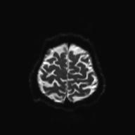Autoimmune limbic encephalitis (Radiopaedia 30363-31005 Axial B0 and DWI 28).jpg