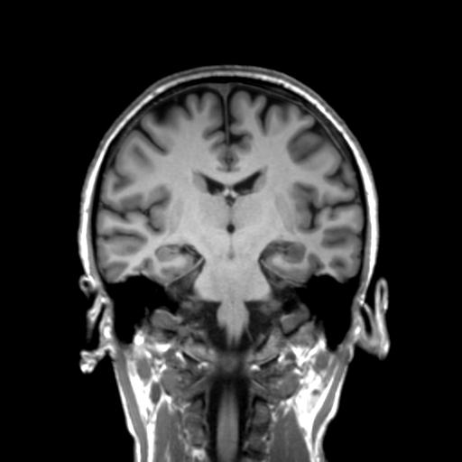 Autoimmune limbic encephalitis (Radiopaedia 30363-31005 Coronal T1 28).jpg