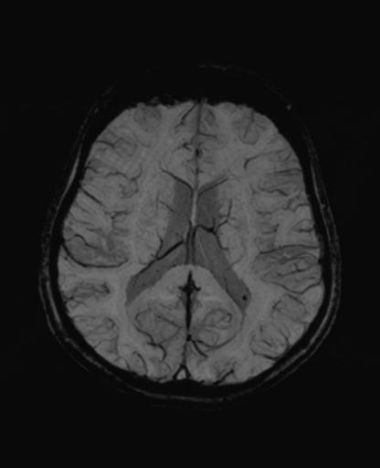 Autoimmune limbic encephalitis (Radiopaedia 30363-31005 SWI - mIP 43).jpg