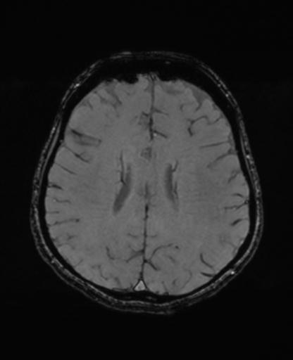 Autoimmune limbic encephalitis (Radiopaedia 30363-31005 SWI - magnitude 51).jpg