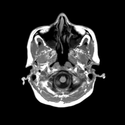 Autoimmune limbic encephalitis (Radiopaedia 30363-31005 T1 Axial 3mm 7).jpg