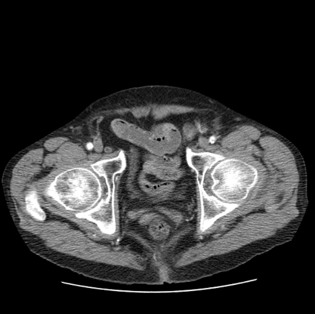 Autosomal dominant polycystic kidney disease (Radiopaedia 27851-28094 B 116).jpg