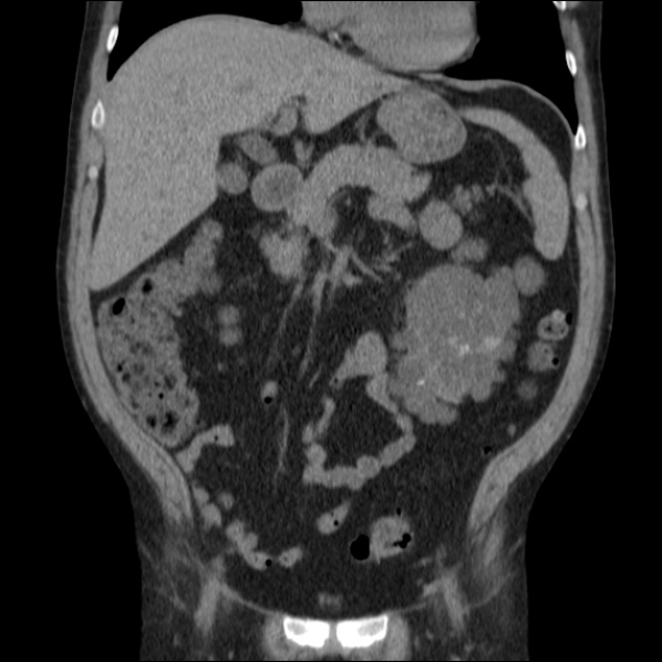 File:Autosomal dominant polycystic kidney disease (Radiopaedia 36539-38101 C 27).jpg