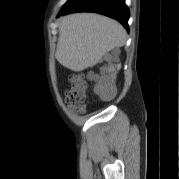 File:Autosomal dominant polycystic kidney disease (Radiopaedia 36539-38101 D 14).jpg