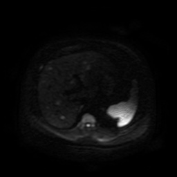 Autosomal dominant polycystic kidney disease (Radiopaedia 50259-55611 Axial DWI 84).jpg