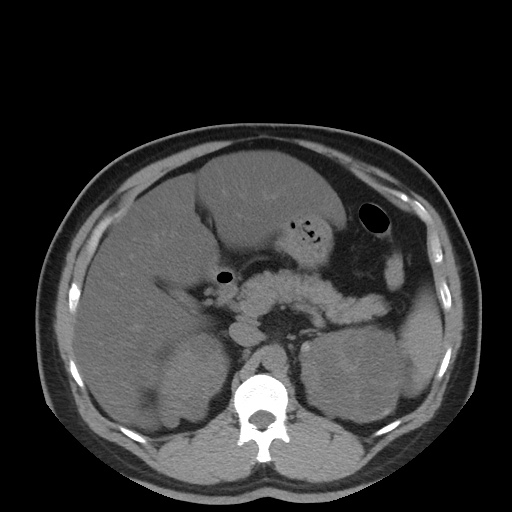 File:Autosomal dominant polycystic kidney disease (Radiopaedia 50259-55612 Axial non-contrast 30).jpg