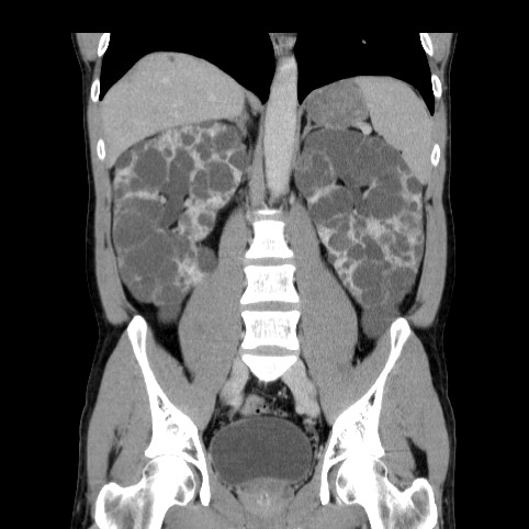 File:Autosomal dominant polycystic kidney disease (Radiopaedia 66349-75582 A 51).jpg