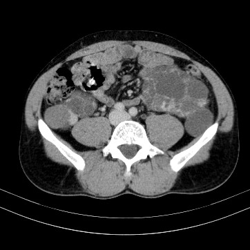 Autosomal dominant polycystic kidney disease (Radiopaedia 66349-75582 B 67).jpg