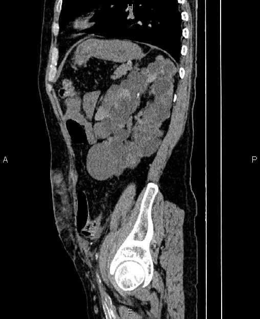 Autosomal dominant polycystic kidney disease (Radiopaedia 87830-104287 C 70).jpg