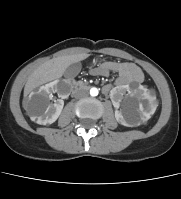 Autosomal dominant polycystic kidney disease - early onset (Radiopaedia 40734-43387 B 34).jpg