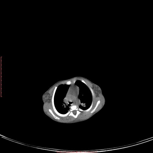 Autosomal recessive polycystic kidney disease associated with Caroli disease (Radiopaedia 61932-69984 B 35).jpg