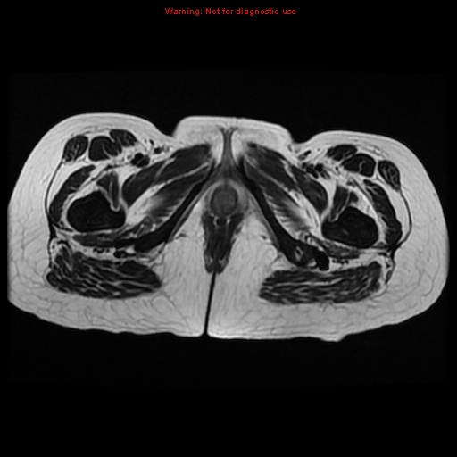 File:Avascular necrosis in sickle cell disease (Radiopaedia 17448-17151 Axial T2 17).jpg