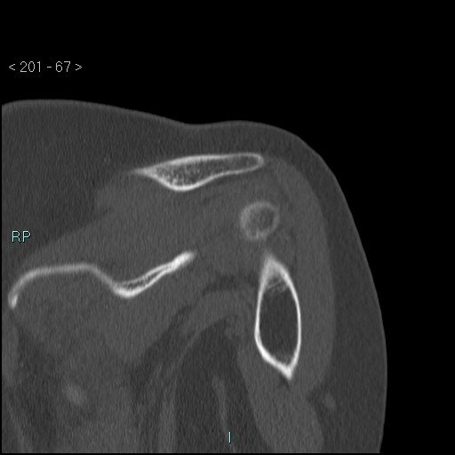 Avascular necrosis of the shoulder - Cruess stage I (Radiopaedia 77674-89887 Coronal bone window 66).jpg